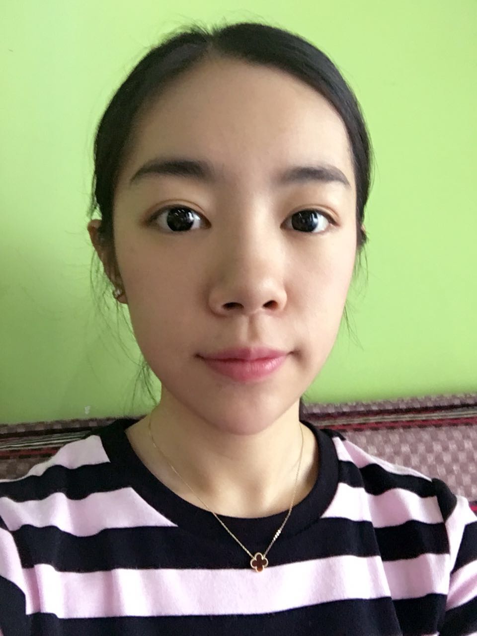 做完祛眼袋手術4天