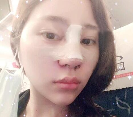蘇州明基醫(yī)院醫(yī)療美容科做鼻綜合整形怎么樣？蘇州明基鼻綜合整形案例