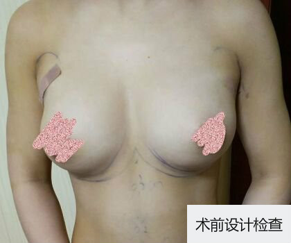 深圳博美整形醫(yī)生劉超做自體脂肪隆胸怎么樣？自體脂肪隆胸案例