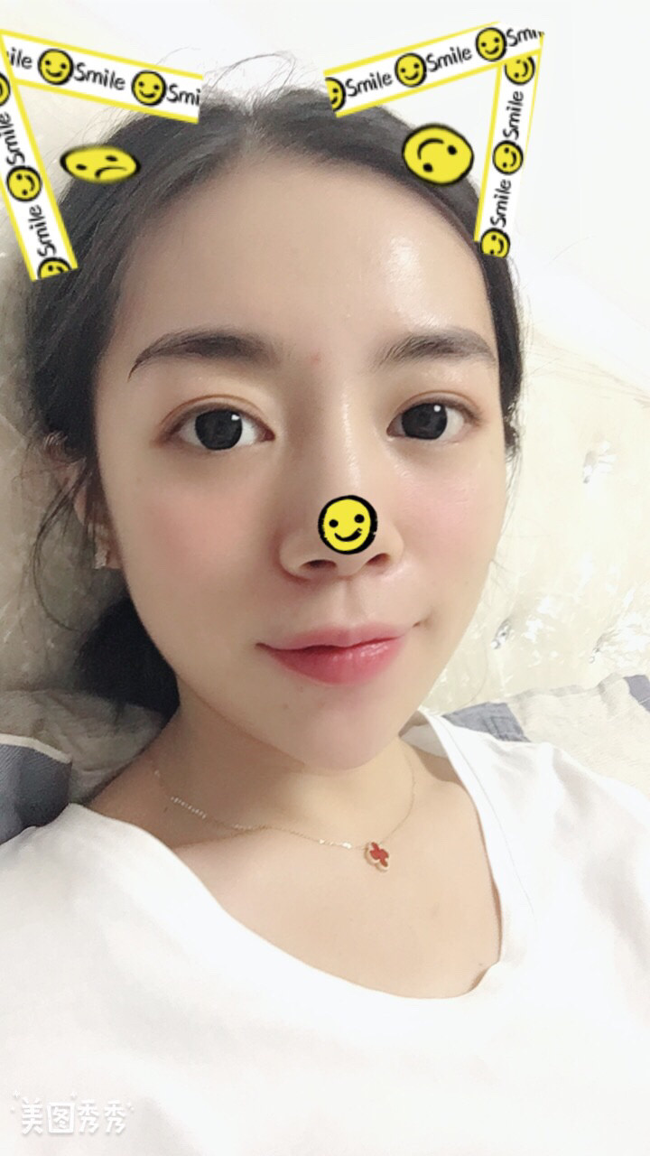 做完祛眼袋手術22天