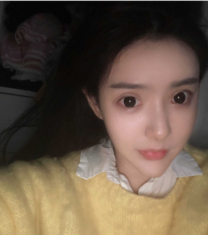 重慶柏漫醫(yī)療美容診所高紅艷醫(yī)生做面部吸脂怎么樣？面部吸脂案例分享