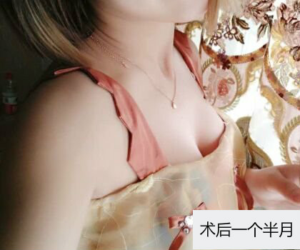 深圳博美整形醫(yī)生劉超做自體脂肪隆胸怎么樣？自體脂肪隆胸案例