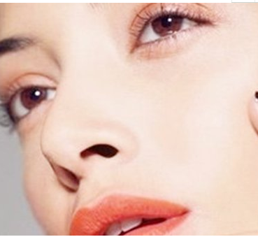 郴州市第四人民醫(yī)院假體隆鼻