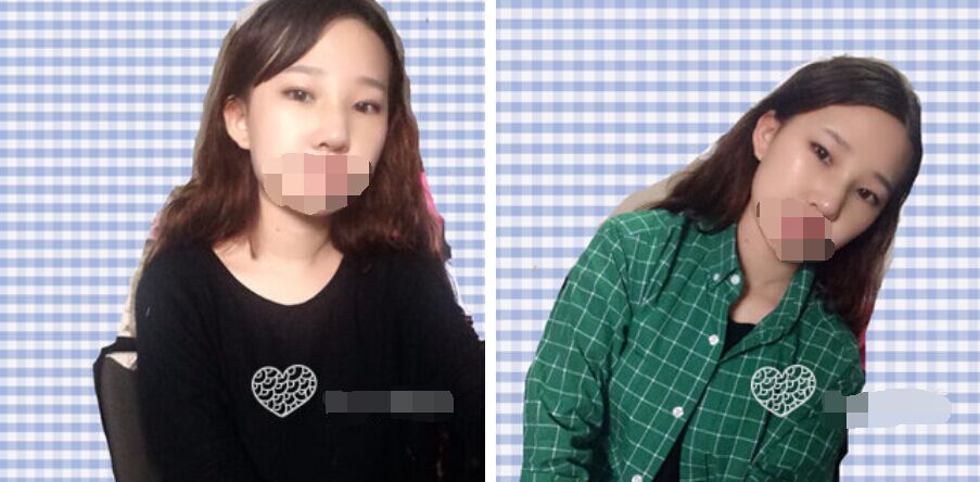 珠海艾瑞醫(yī)療美容醫(yī)院余昌盛醫(yī)生做耳軟骨隆鼻真實(shí)案例分享 珠海艾瑞醫(yī)療美容醫(yī)院余昌盛醫(yī)生做耳軟骨隆鼻真實(shí)案例分享