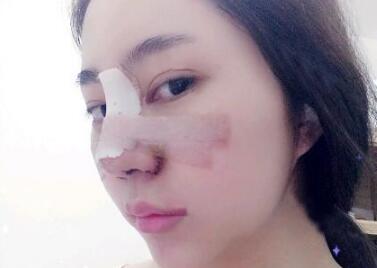 蘇州明基醫(yī)院醫(yī)療美容科做鼻綜合整形怎么樣？蘇州明基鼻綜合整形案例