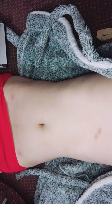 深圳晨曦整形醫(yī)院吉米斯做腰腹吸脂怎么樣？附吉米斯醫(yī)生腰腹吸脂案例