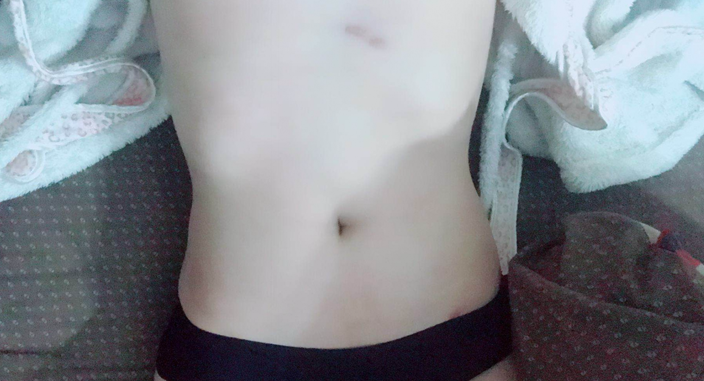 深圳晨曦整形醫(yī)院吉米斯做腰腹吸脂怎么樣？附吉米斯醫(yī)生腰腹吸脂案例