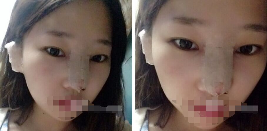 珠海艾瑞醫(yī)療美容醫(yī)院余昌盛醫(yī)生做耳軟骨隆鼻真實(shí)案例分享 珠海艾瑞醫(yī)療美容醫(yī)院余昌盛醫(yī)生做耳軟骨隆鼻真實(shí)案例分享