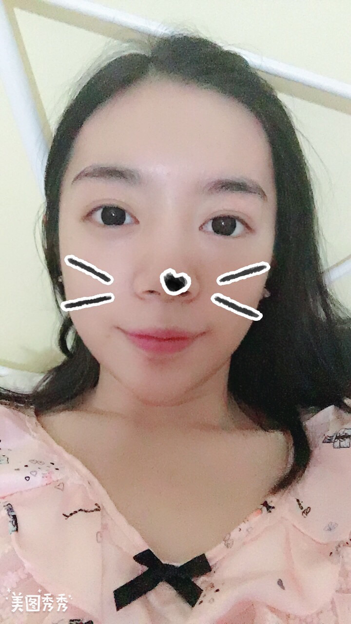 做完祛眼袋手術41天