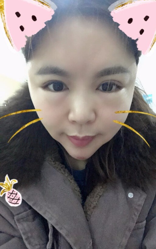 重慶聯(lián)合麗格美容醫(yī)院林麗蓉醫(yī)生做自體脂肪豐蘋果肌怎么樣？附案例