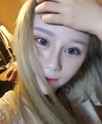 長春奧拉克美容醫(yī)院金相勛醫(yī)生做玻尿酸豐臥蠶怎么樣？附案例