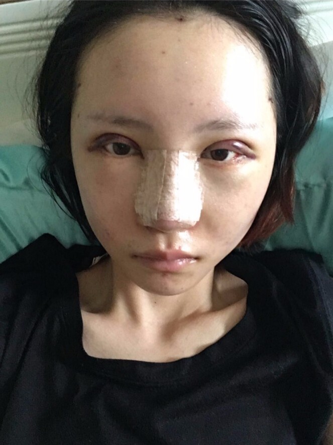 長(zhǎng)沙愛(ài)思特整形醫(yī)院陳星光醫(yī)生做鼻部多項(xiàng)+自體脂肪隆鼻+切開(kāi)雙眼皮+開(kāi)外眼角案例 長(zhǎng)沙愛(ài)思特整形醫(yī)院陳星光醫(yī)生做鼻部多項(xiàng)+自體脂肪隆鼻+切開(kāi)雙眼皮+開(kāi)外眼角案例