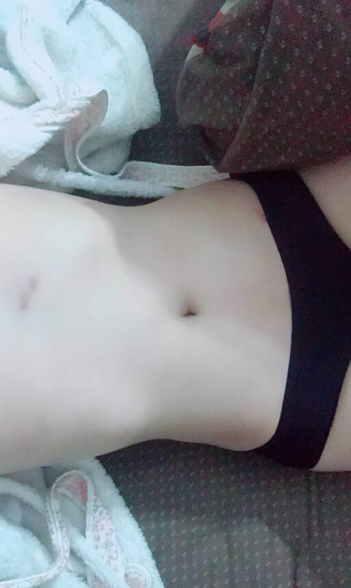 襄陽(yáng)維多利亞整形醫(yī)院做腰腹吸脂怎么樣？張世蓮腰腹吸脂案例分享