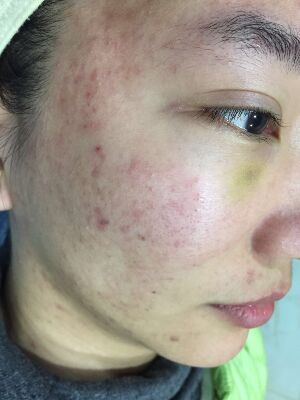 重慶柏漫醫(yī)療美容診所做激光祛痘效果怎么樣？白亞亞激光祛痘案例