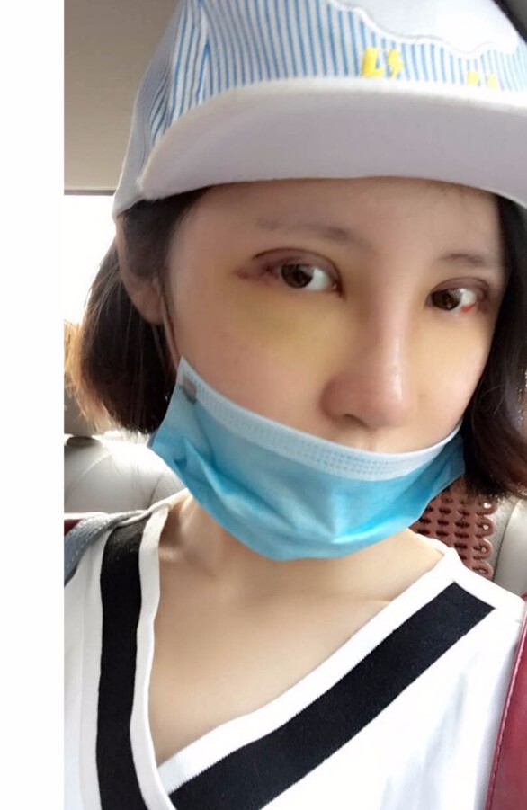 長(zhǎng)沙愛(ài)思特整形醫(yī)院陳星光醫(yī)生做鼻部多項(xiàng)+自體脂肪隆鼻+切開(kāi)雙眼皮+開(kāi)外眼角案例 長(zhǎng)沙愛(ài)思特整形醫(yī)院陳星光醫(yī)生做鼻部多項(xiàng)+自體脂肪隆鼻+切開(kāi)雙眼皮+開(kāi)外眼角案例