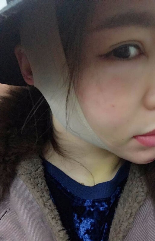 重慶聯(lián)合麗格美容醫(yī)院林麗蓉醫(yī)生做自體脂肪豐蘋果肌怎么樣？附案例