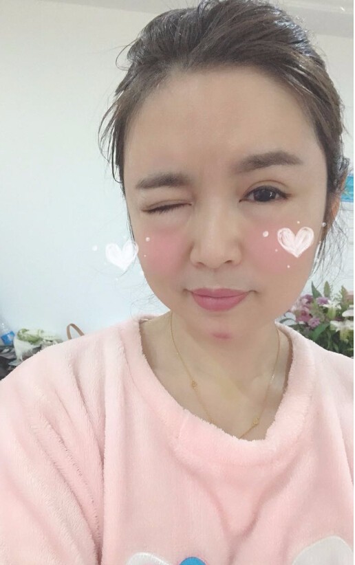 重慶聯(lián)合麗格美容醫(yī)院林麗蓉醫(yī)生做自體脂肪豐蘋果肌怎么樣？附案例