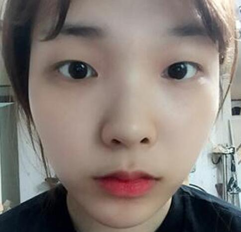 象山華美整形美容醫(yī)院趙誠(chéng)厚醫(yī)生做切開雙眼皮+開內(nèi)眼角整形案例