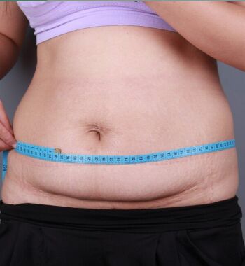 武漢東方麗人醫(yī)院整形美容科胡江偉醫(yī)生做腰腹吸脂案例效果對比圖 武漢東方麗人醫(yī)院整形美容科胡江偉醫(yī)生做腰腹吸脂案例效果對比圖