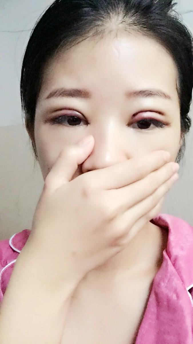 深圳晨曦醫(yī)療整形醫(yī)生吉米斯做切開雙眼皮怎么樣？吉米斯切開雙眼皮案例效果