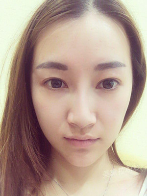 重慶五洲女子醫(yī)院整形美容中心做光子嫩膚怎么樣？淡明斌醫(yī)生光子嫩膚案例