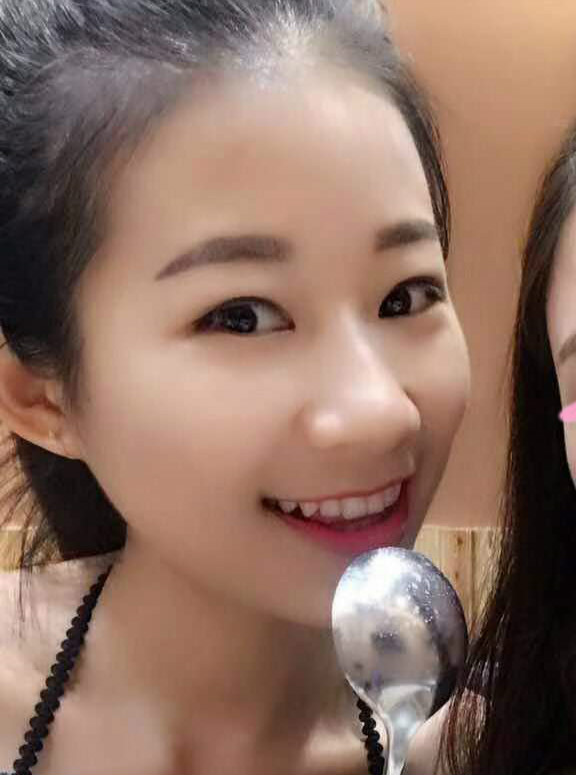 深圳晨曦醫(yī)療整形醫(yī)生吉米斯做切開雙眼皮怎么樣？吉米斯切開雙眼皮案例效果