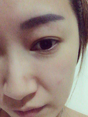 重慶五洲女子醫(yī)院整形美容中心做光子嫩膚怎么樣？淡明斌醫(yī)生光子嫩膚案例