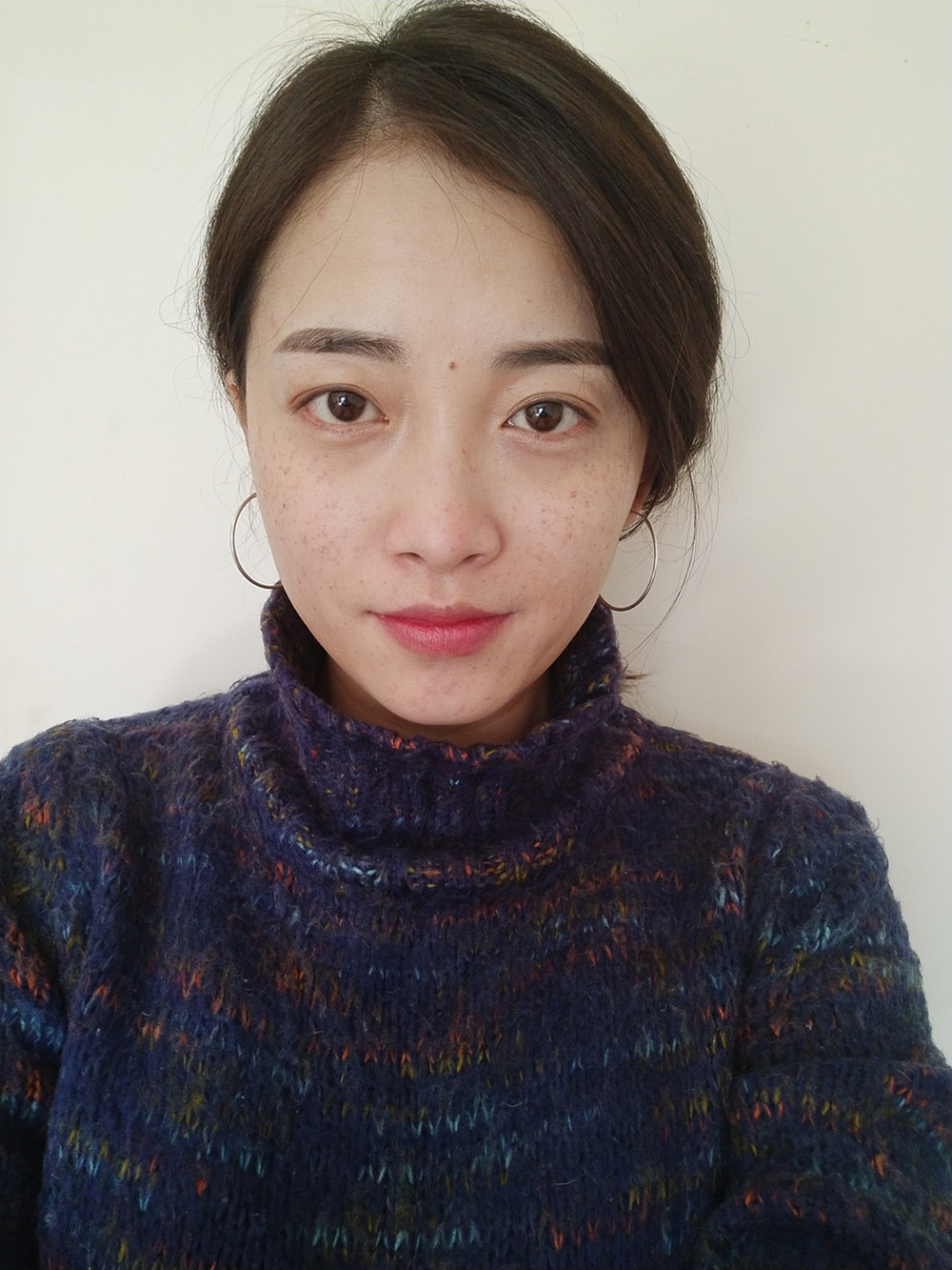 重慶當(dāng)代整形李敏旭醫(yī)生做皮秒激光祛斑效果怎么樣？附皮秒激光祛斑案例