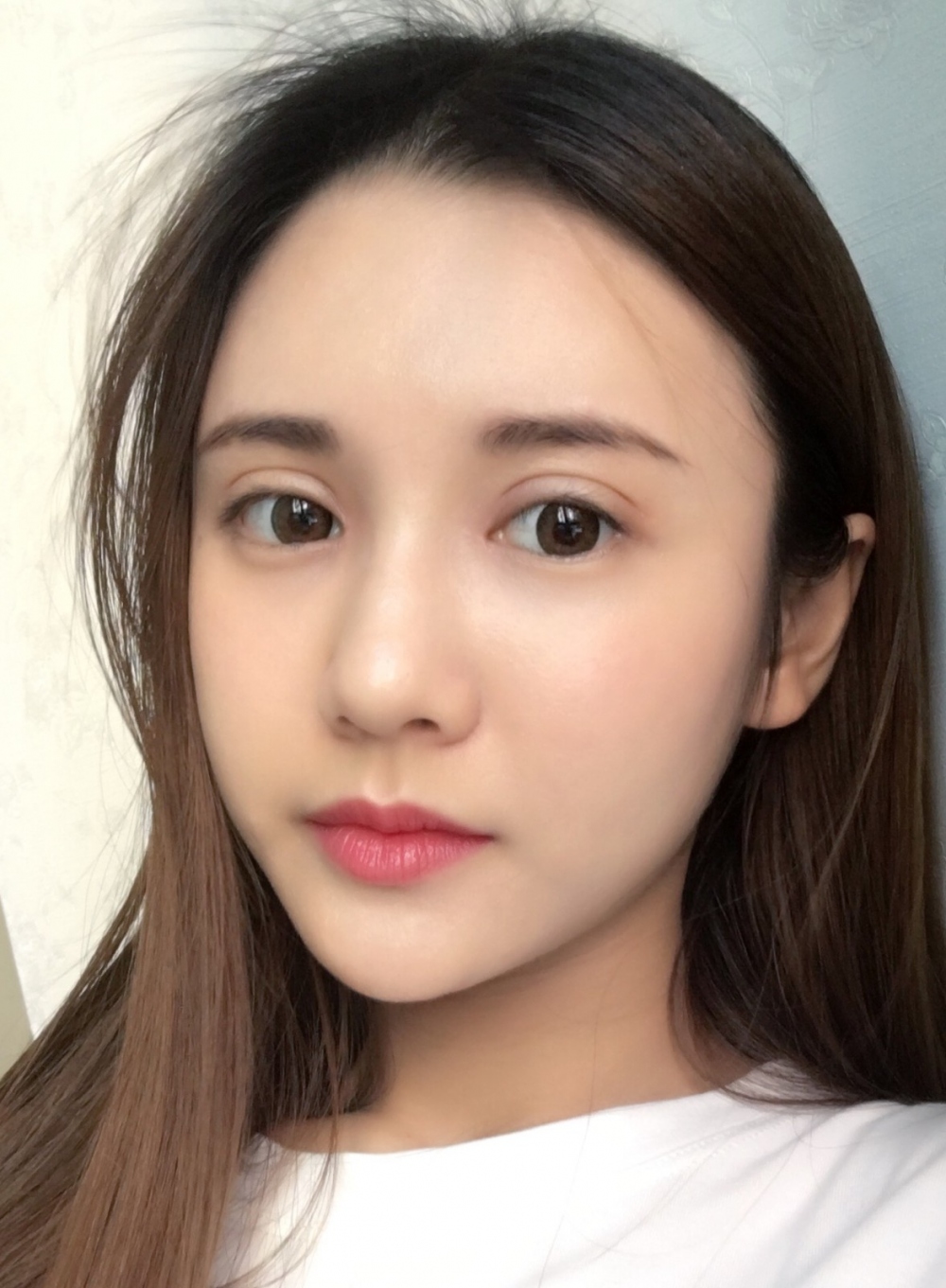 鄭州銘藝整形醫(yī)生陳濤做切開雙眼皮怎么樣？鄭州銘藝切開雙眼皮案例