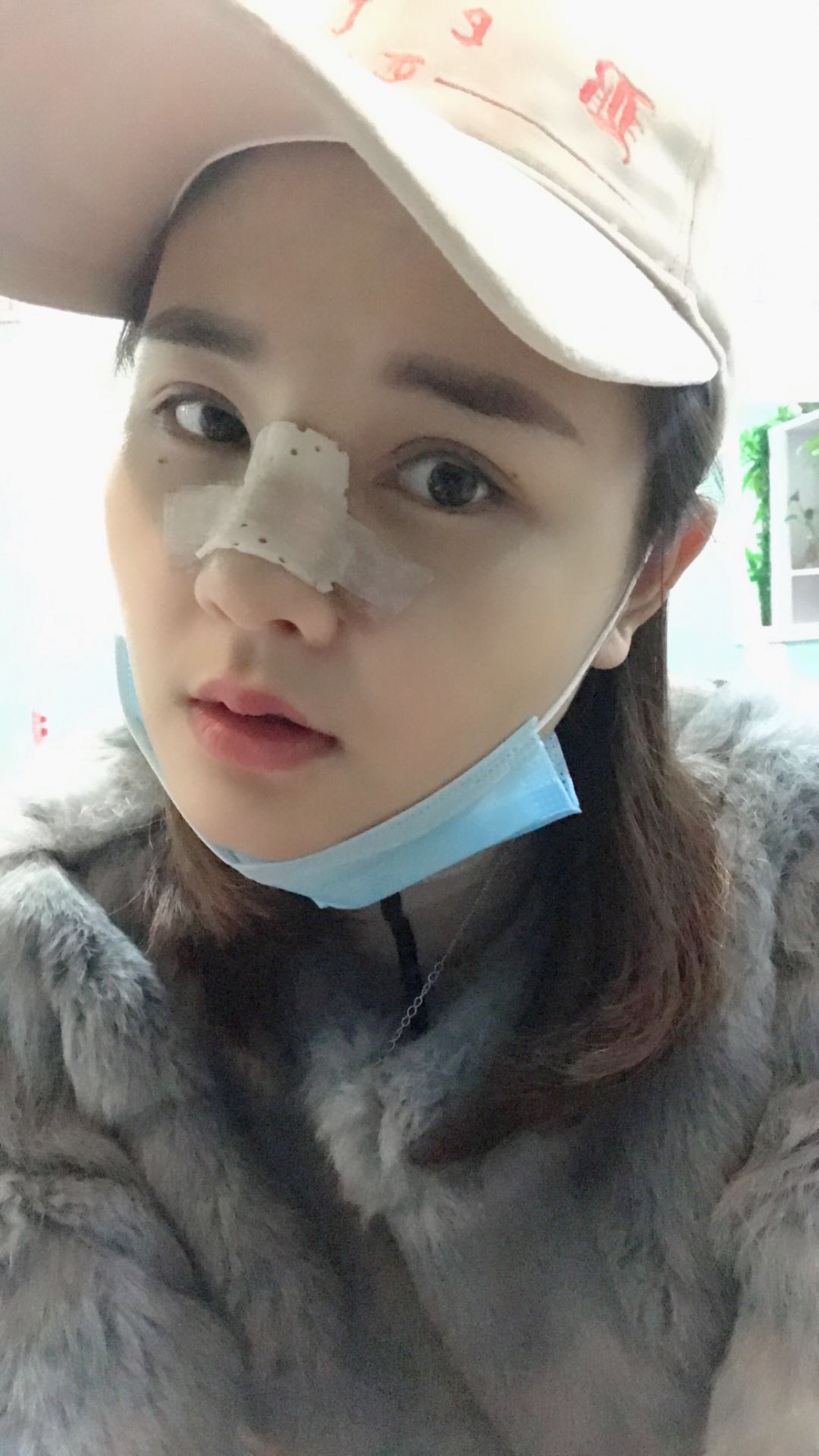 鄭州華領(lǐng)醫(yī)療美容醫(yī)院賀小虎醫(yī)生做眼綜合+鼻部整形手術(shù)效果怎么樣？