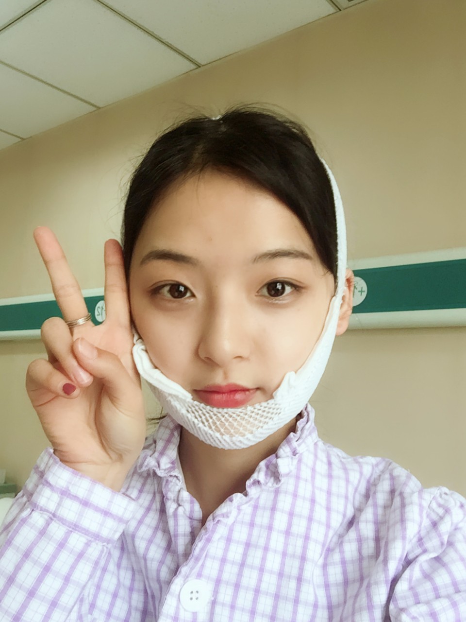 鄭州名門整形醫(yī)院董斌醫(yī)生做下頜角整形怎么樣？附下頜角整形案例