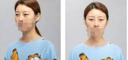 太原歐美蓮整形醫(yī)院丁曉峰醫(yī)生做雙眼皮怎么樣？丁曉峰雙眼皮手術(shù)案例分享