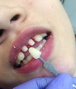 武漢康承貝健口腔醫(yī)院宋磊醫(yī)生做二氧化鋯全瓷牙效果怎么樣？附案例