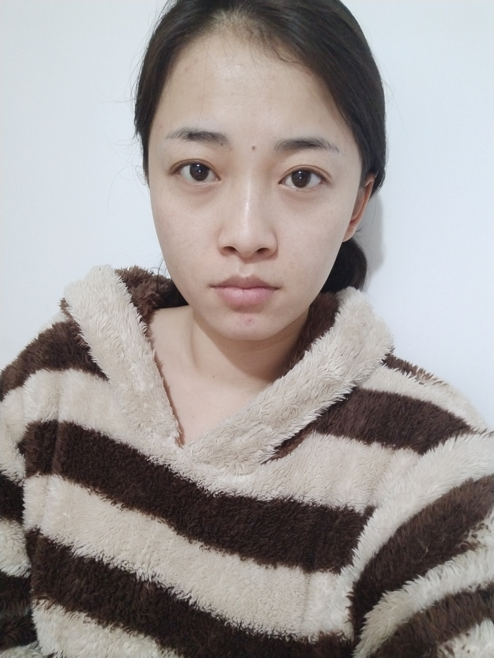 重慶當(dāng)代整形李敏旭醫(yī)生做皮秒激光祛斑效果怎么樣？附皮秒激光祛斑案例