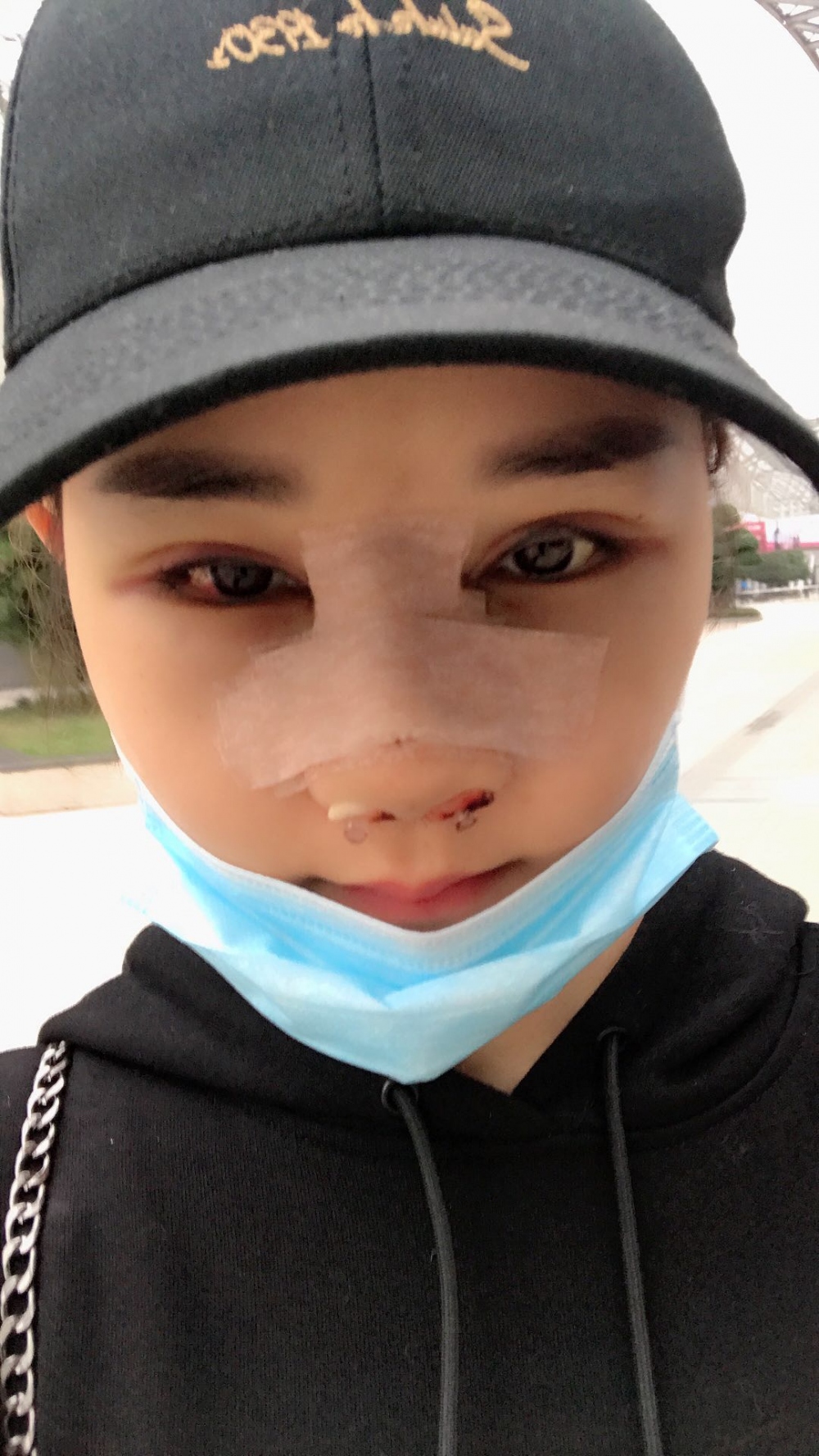 鄭州華領(lǐng)醫(yī)療美容醫(yī)院賀小虎醫(yī)生做眼綜合+鼻部整形手術(shù)效果怎么樣？