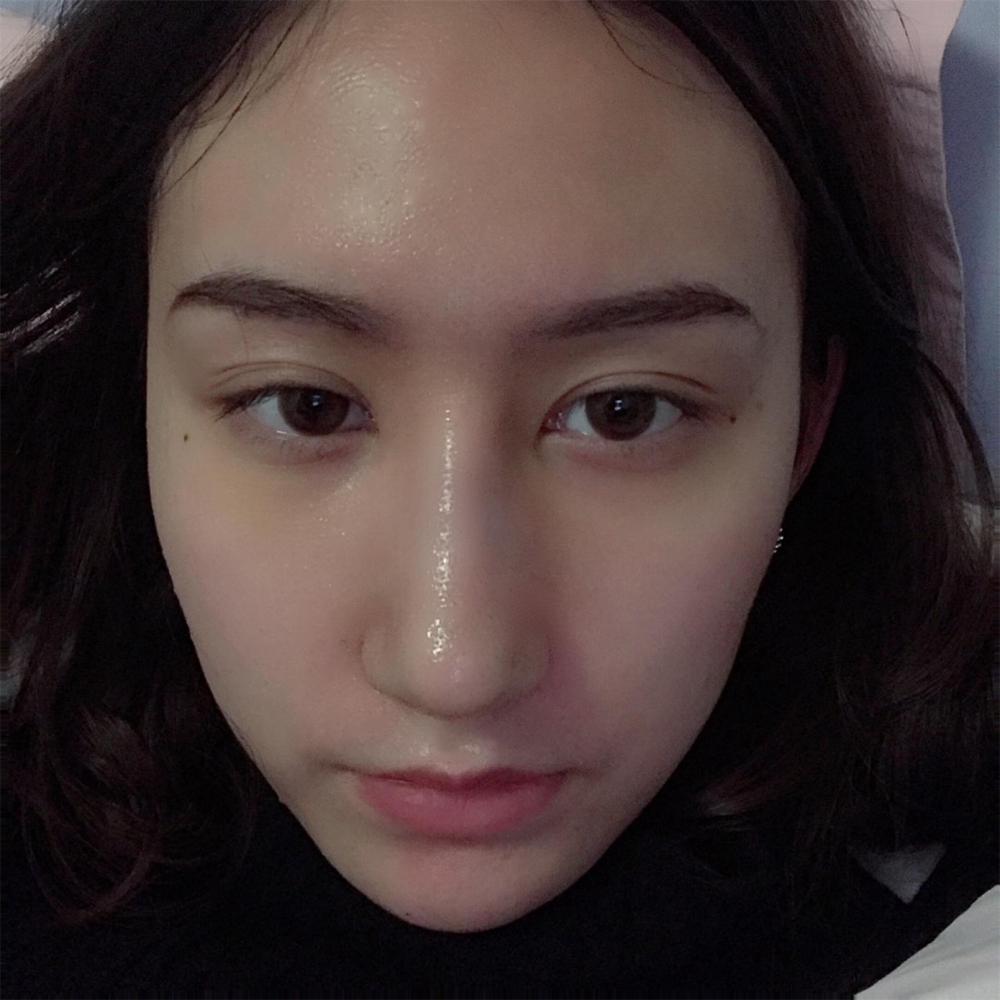 煙臺(tái)洛神醫(yī)學(xué)美容醫(yī)院張瑞允醫(yī)生做硅膠隆鼻怎么樣？附硅膠隆鼻案例