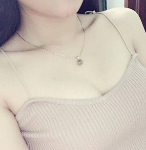 珠海萊茵醫(yī)療美容醫(yī)院崔俊溶醫(yī)生做自體脂肪隆胸效果怎么樣？附自體脂肪隆胸案例