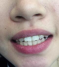 武漢康承貝健口腔醫(yī)院宋磊醫(yī)生做二氧化鋯全瓷牙效果怎么樣？附案例