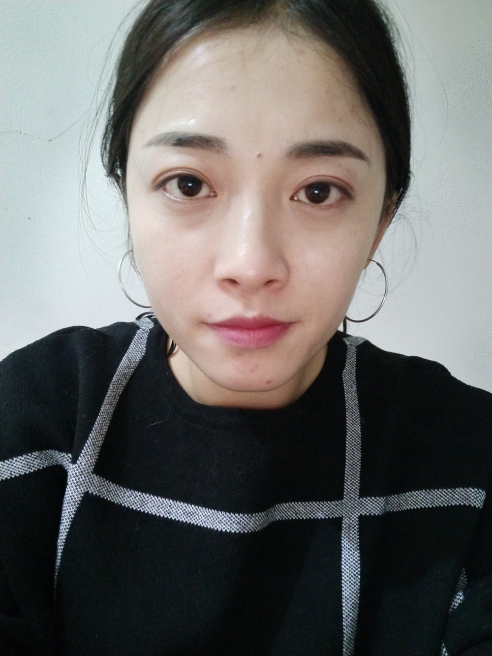 重慶當(dāng)代整形李敏旭醫(yī)生做皮秒激光祛斑效果怎么樣？附皮秒激光祛斑案例