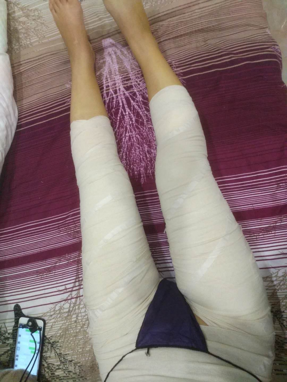 宜春美萊醫(yī)療整形醫(yī)生黃治林做自體脂肪隆胸怎么樣？附案例