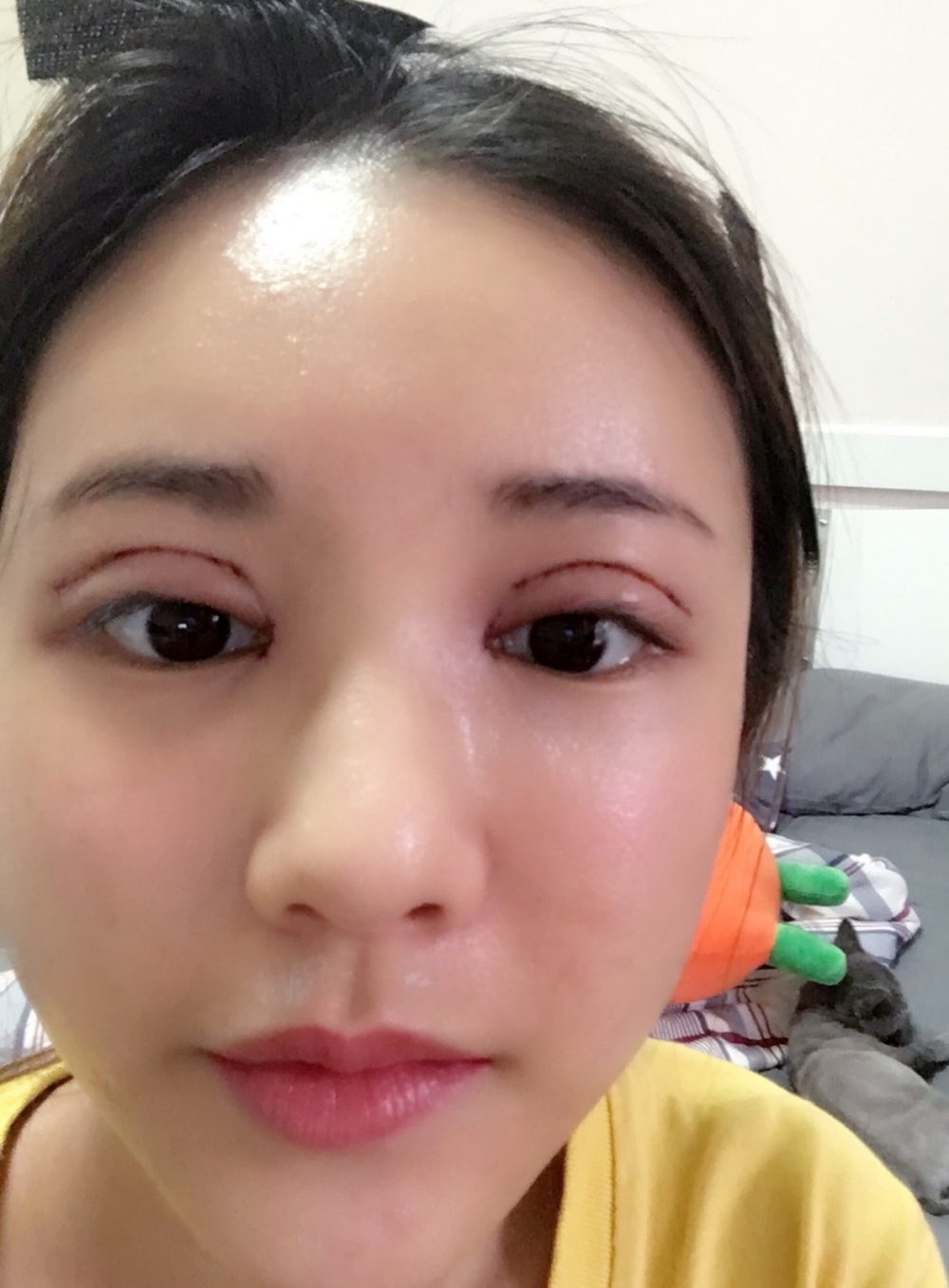 鄭州銘藝整形醫(yī)生陳濤做切開雙眼皮怎么樣？鄭州銘藝切開雙眼皮案例