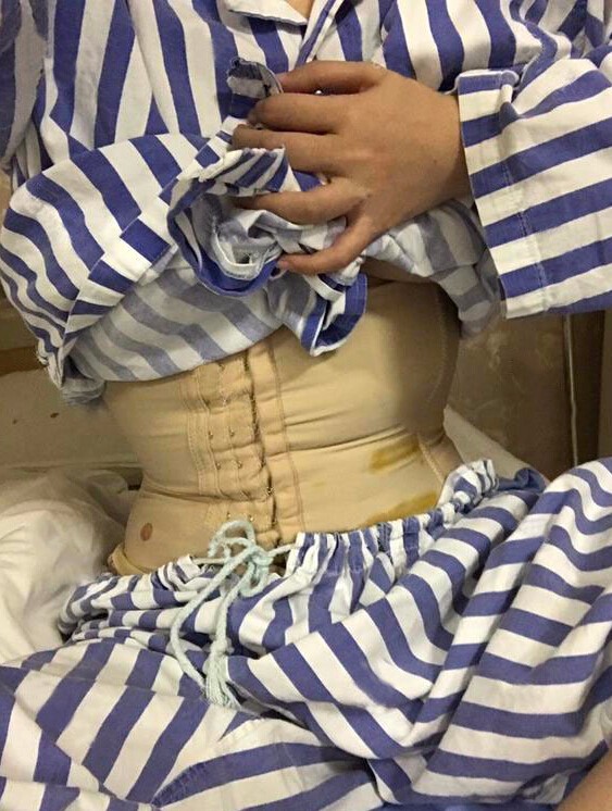 長沙亞韓醫(yī)學整形醫(yī)生米勒做腰腹吸脂效果怎么樣？米勒腰腹吸脂案例