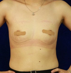 珠海萊茵醫(yī)療美容醫(yī)院崔俊溶醫(yī)生做自體脂肪隆胸效果怎么樣？附自體脂肪隆胸案例