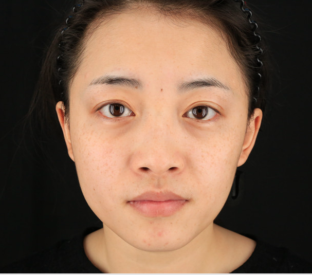 重慶當(dāng)代整形李敏旭醫(yī)生做皮秒激光祛斑效果怎么樣？附皮秒激光祛斑案例