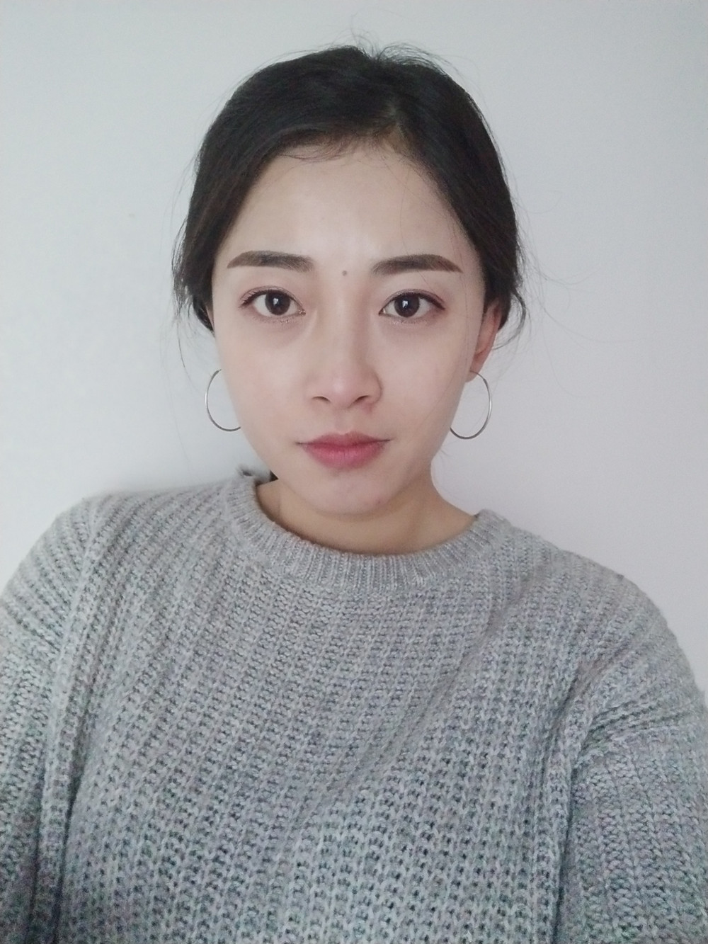 重慶當(dāng)代整形李敏旭醫(yī)生做皮秒激光祛斑效果怎么樣？附皮秒激光祛斑案例