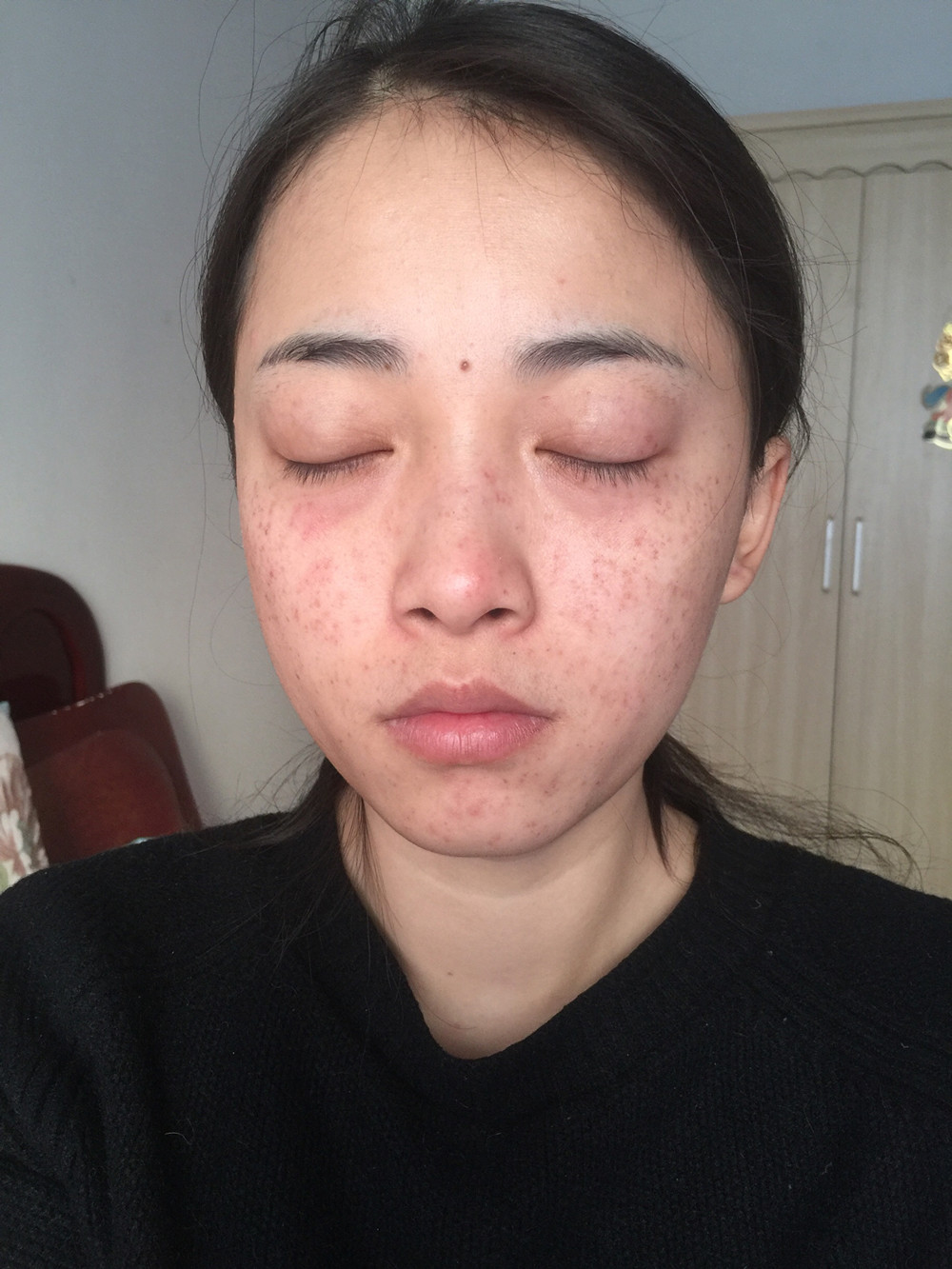 重慶當(dāng)代整形李敏旭醫(yī)生做皮秒激光祛斑效果怎么樣？附皮秒激光祛斑案例