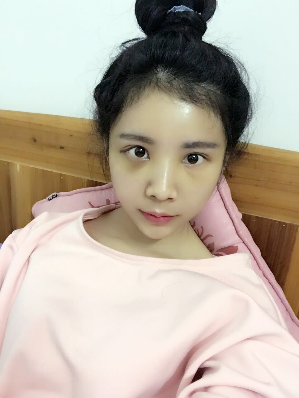 西安高一生醫(yī)療美容醫(yī)院網(wǎng)購恒醫(yī)生做自體脂肪全臉填充案例效果對比圖 西安高一生醫(yī)療美容醫(yī)院網(wǎng)購恒醫(yī)生做自體脂肪全臉填充案例效果對比圖