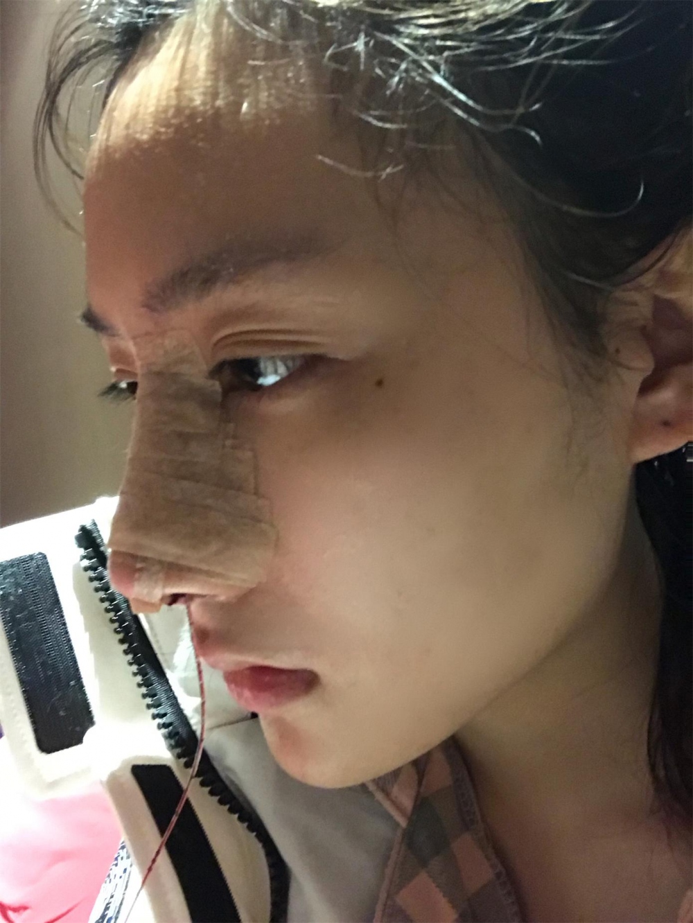 煙臺(tái)洛神醫(yī)學(xué)美容醫(yī)院張瑞允醫(yī)生做硅膠隆鼻怎么樣？附硅膠隆鼻案例