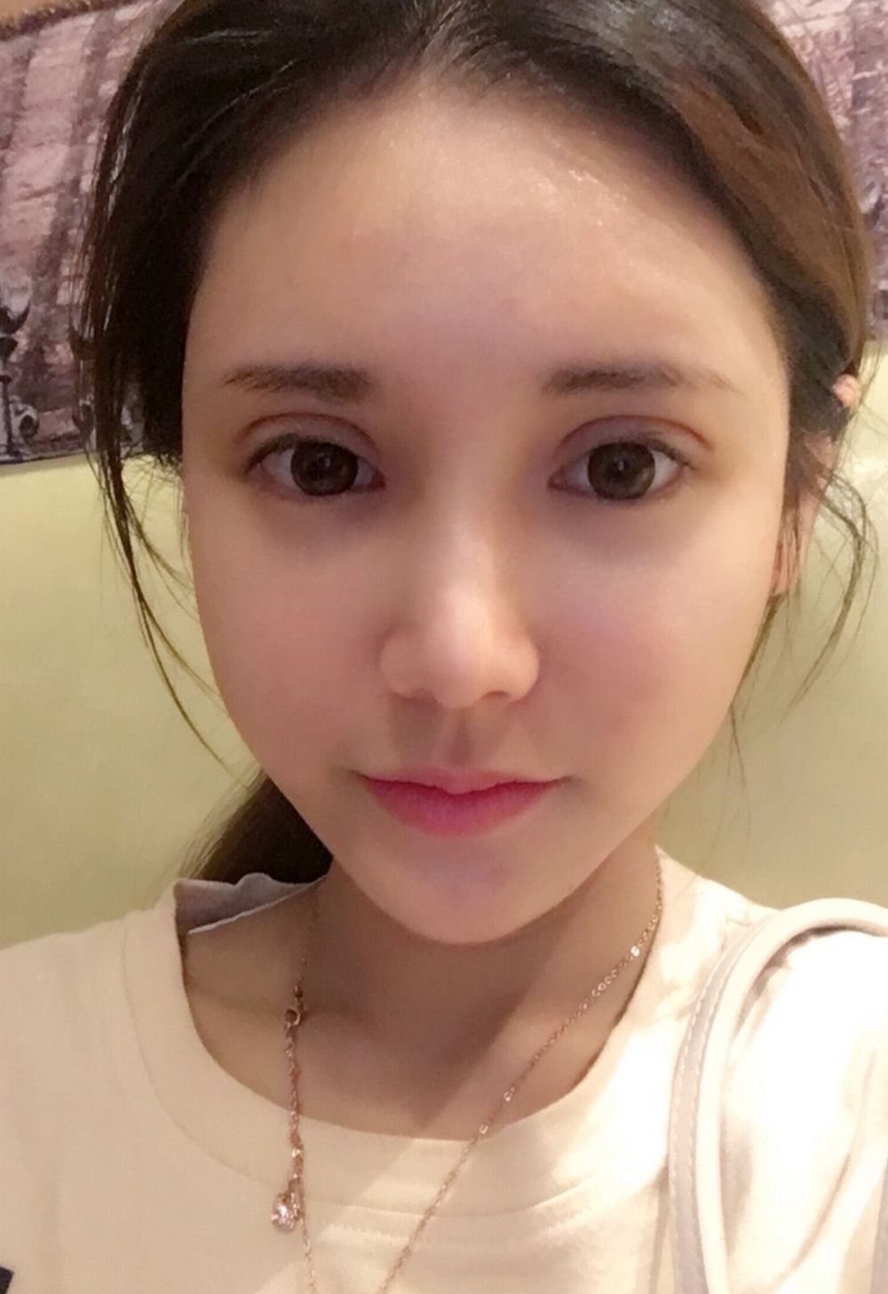 鄭州銘藝整形醫(yī)生陳濤做切開雙眼皮怎么樣？鄭州銘藝切開雙眼皮案例