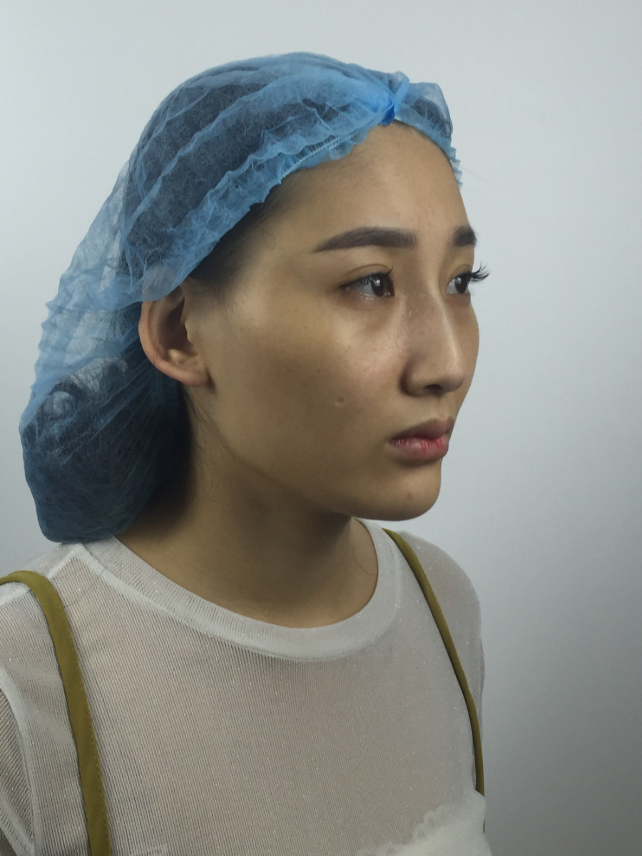 武漢中翰整形外科醫(yī)院沈磊醫(yī)生做切開雙眼皮怎么樣？附沈磊切開雙眼皮案例